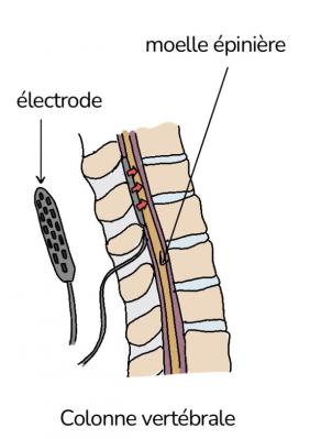 Implantation